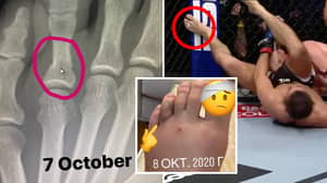 Khabib Posts Pictures Of Broken Foot He Suffered Just Three Weeks Before Justin Gaethje Fight