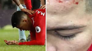 Marcos Rojo Reveals Nasty Head Wound Suffered In Manchester Derby 