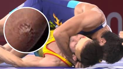 Olympic Wrestler Left With Huge Teeth Marks On Bicep After Being Bitten By Rival