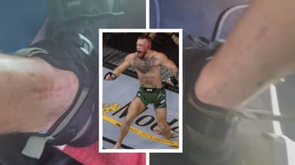 Conor McGregor Shows Off Massive Scars After Surgery On Snapped Leg