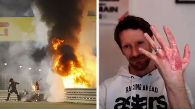 Romain Grosjean Shows Off Huge Hand Burns 12 Months After Horror F1 Crash