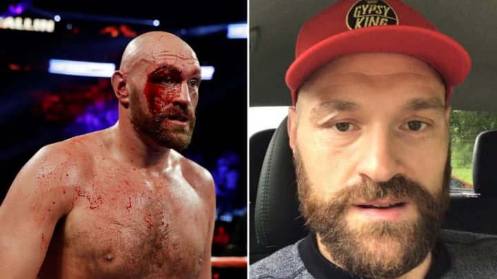 Tyson Fury Says He Feels "Fantastic" After Removing 48 Stitches From His Eye