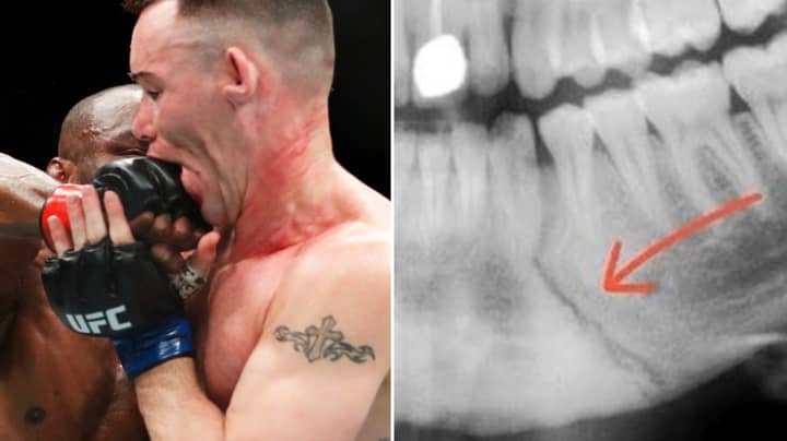 Colby Covington Shows Off Grim X-Ray Of Broken Jaw After Being Smashed By Kamaru Usman