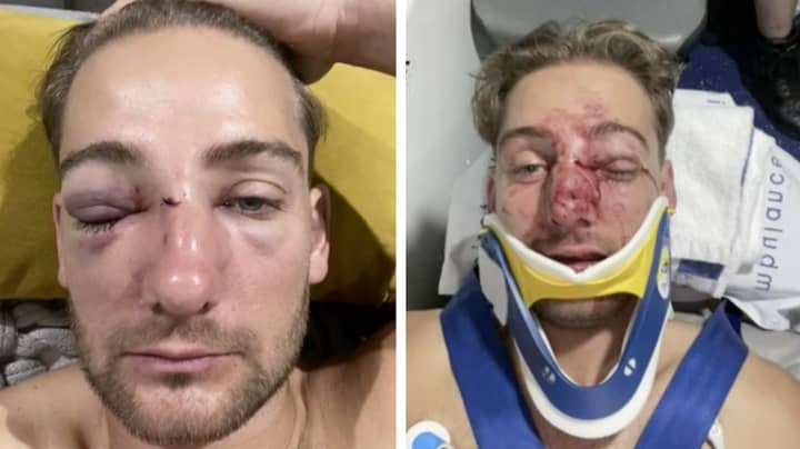 Local Aussie Rules Player Shows Off Face Injuries After One-Punch Attack