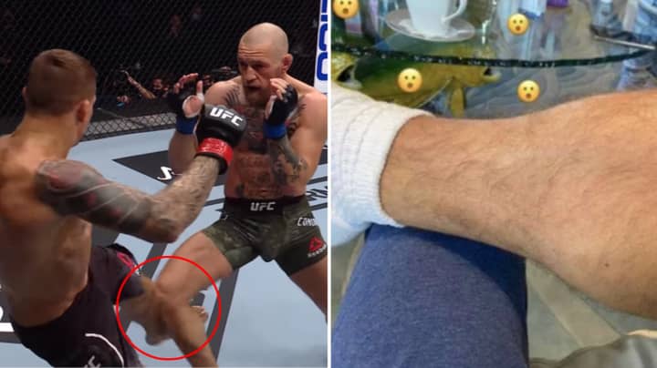 Conor McGregor's Leg Is Still Seriously Messed Up After Those Dustin Poirier Kicks 